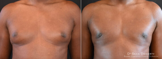 Gynecomastia Before and After Photos in Boston, MA, Patient 7758