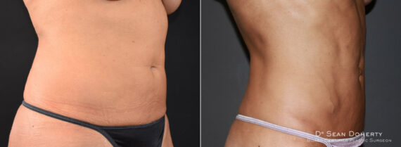 Liposuction Before and After Photos in Boston, MA, Patient 7797
