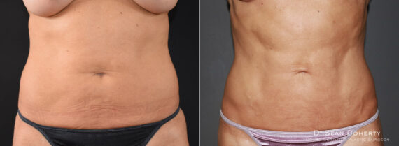 Liposuction Before and After Photos in Boston, MA, Patient 7797