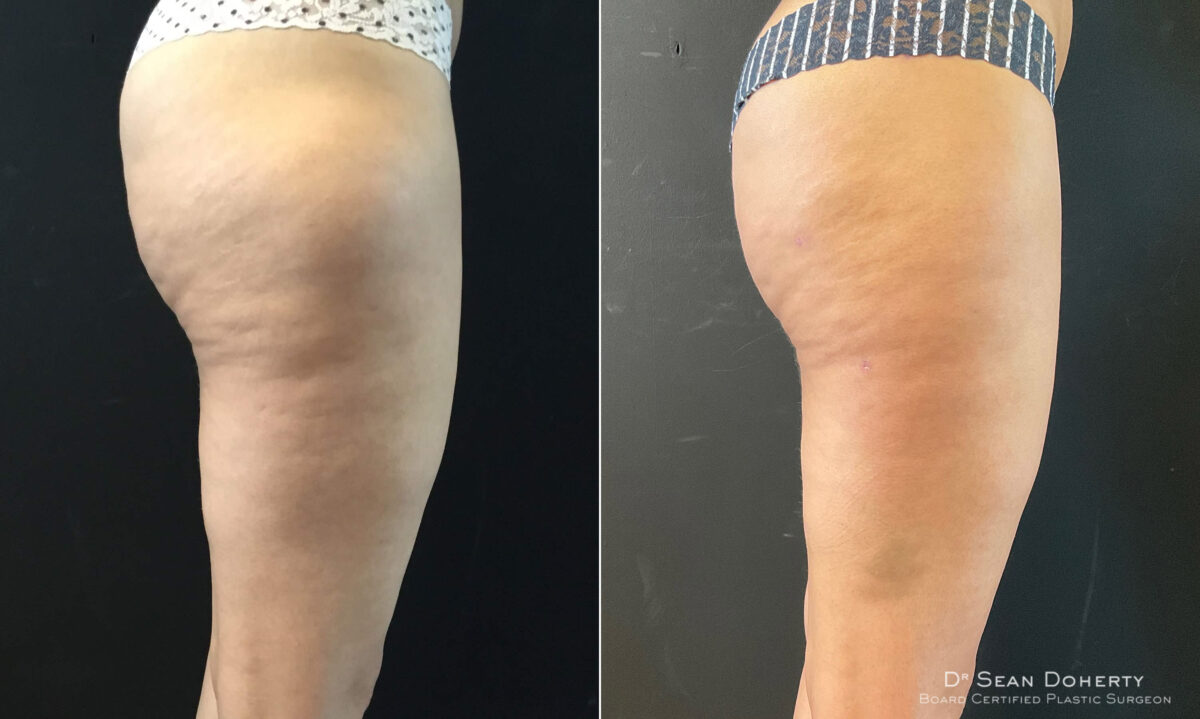 Liposuction Before and After Photos in Boston, MA, Patient 7798