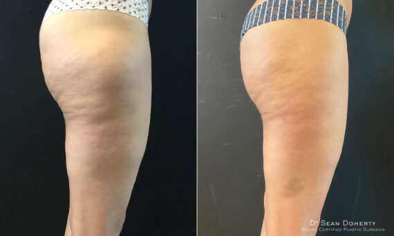 Liposuction Before and After Photos in Boston, MA, Patient 7798