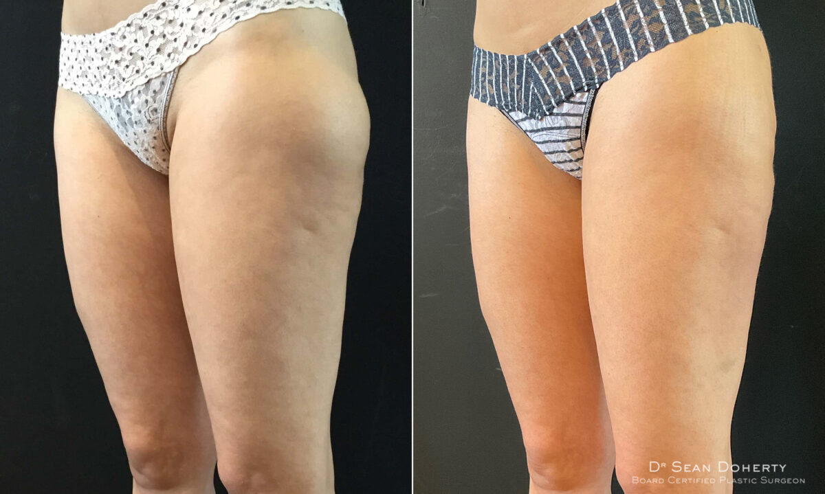 Liposuction Before and After Photos in Boston, MA, Patient 7798
