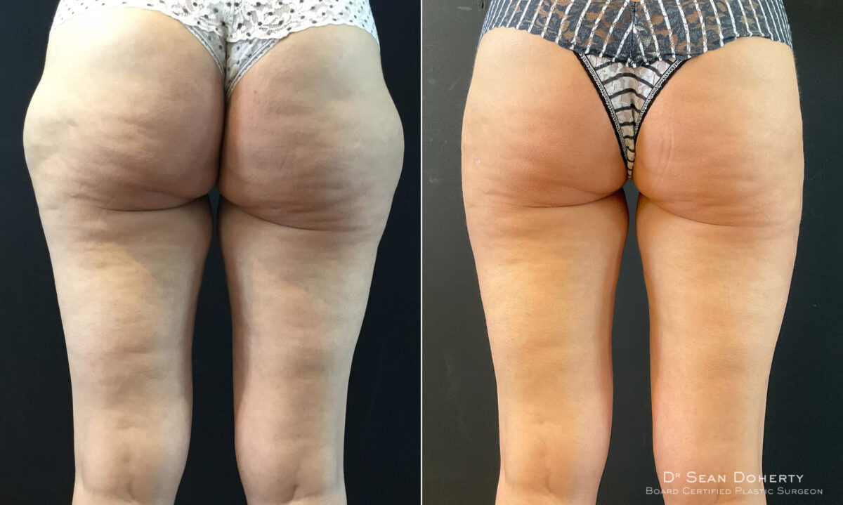 Liposuction Before and After Photos in Boston, MA, Patient 7798