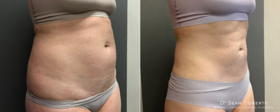 Liposuction Before and After Photos in Boston, MA, Patient 7799