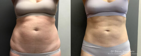 Liposuction Before and After Photos in Boston, MA, Patient 7799