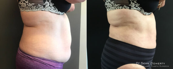 Liposuction Before and After Photos in Boston, MA, Patient 7800