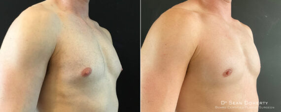 Gynecomastia Before and After Photos in Boston, MA, Patient 7840