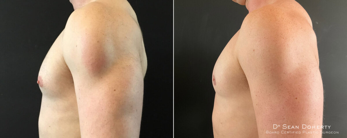 Gynecomastia Before and After Photos in Boston, MA, Patient 7840