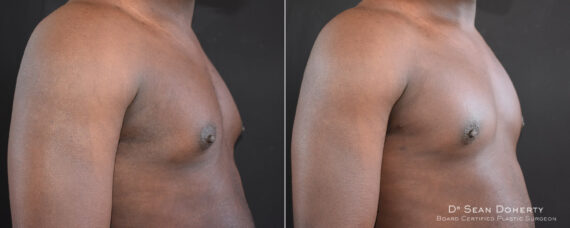 Gynecomastia Before and After Photos in Boston, MA, Patient 7841
