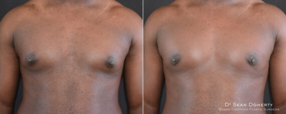 Gynecomastia Before and After Photos in Boston, MA, Patient 7841