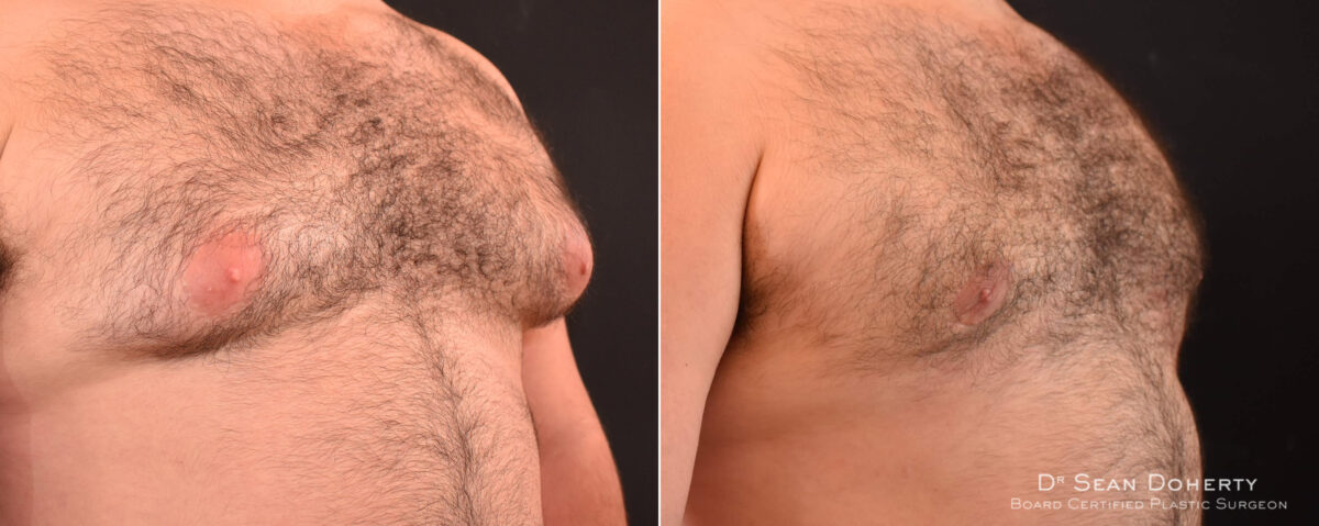 Gynecomastia Before and After Photos in Boston, MA, Patient 7860