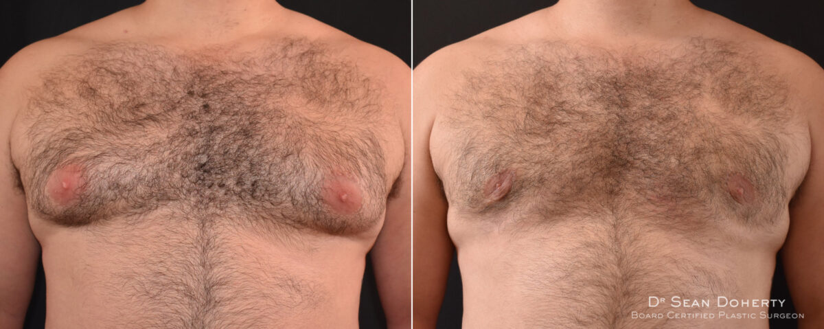 Gynecomastia Before and After Photos in Boston, MA, Patient 7860
