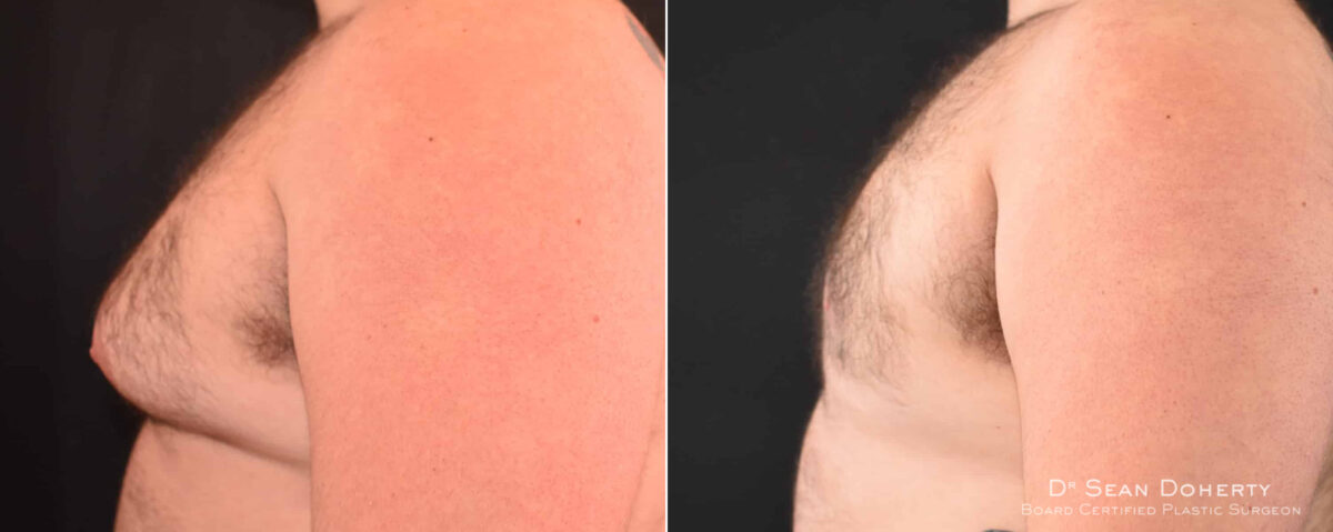 Gynecomastia Before and After Photos in Boston, MA, Patient 7860