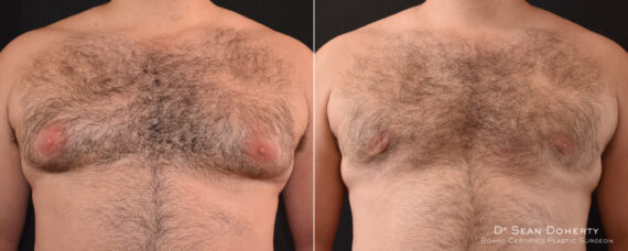 Gynecomastia Before and After Photos in Boston, MA, Patient 7860