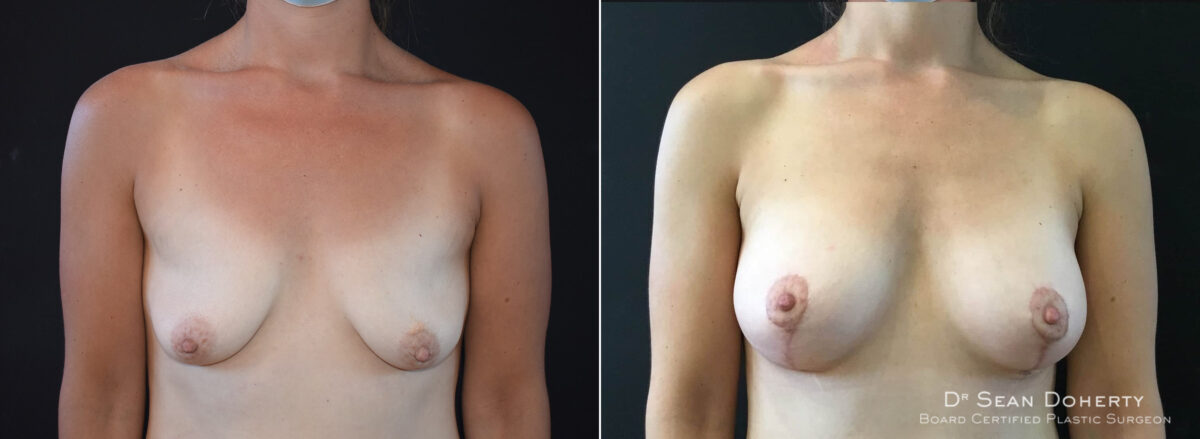 Breast Lift with Implants Before and After Photos in Boston, MA, Patient 8288