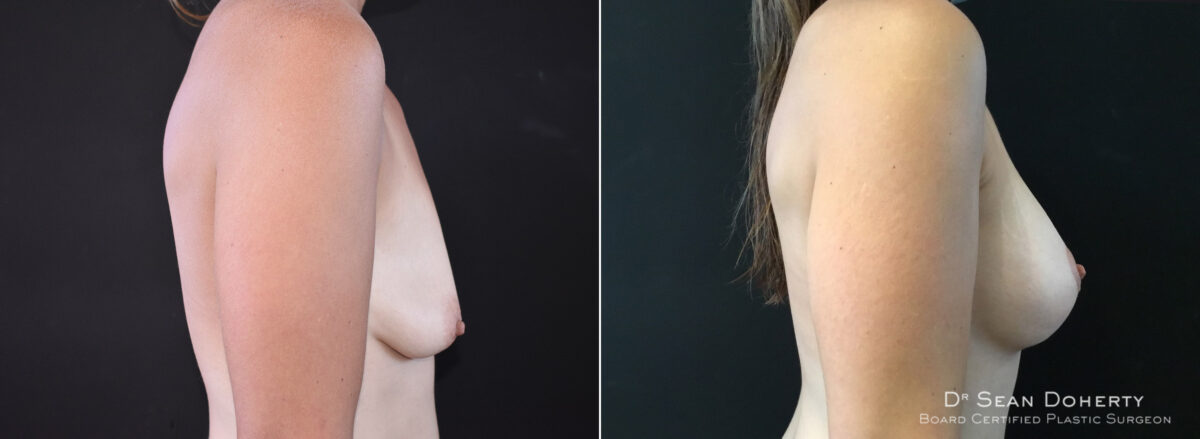 Breast Lift with Implants Before and After Photos in Boston, MA, Patient 8288