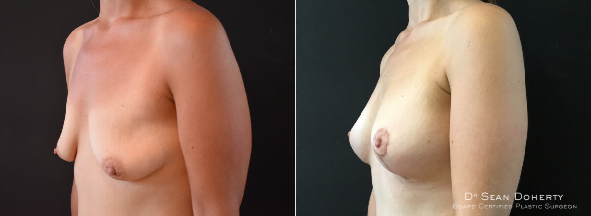 Breast Lift with Implants Before and After Photos in Boston, MA, Patient 8288