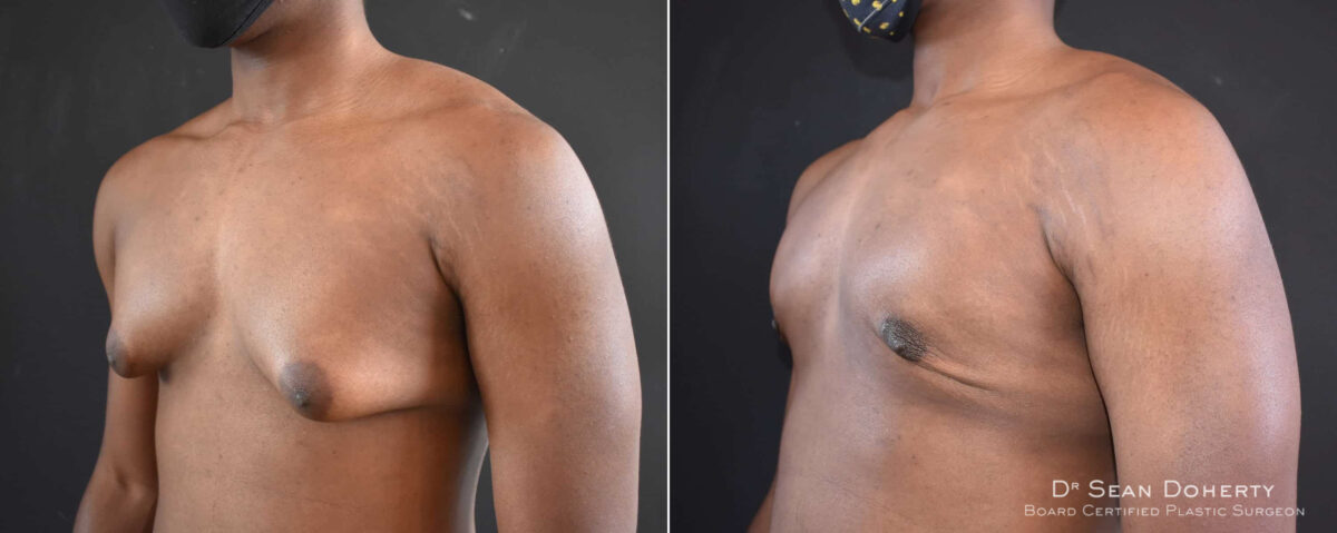 Gynecomastia Before and After Photos in Boston, MA, Patient 8351