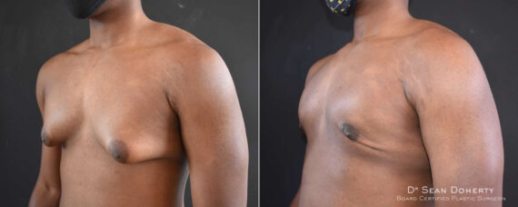 Gynecomastia Before and After Photos in Boston, MA, Patient 8351