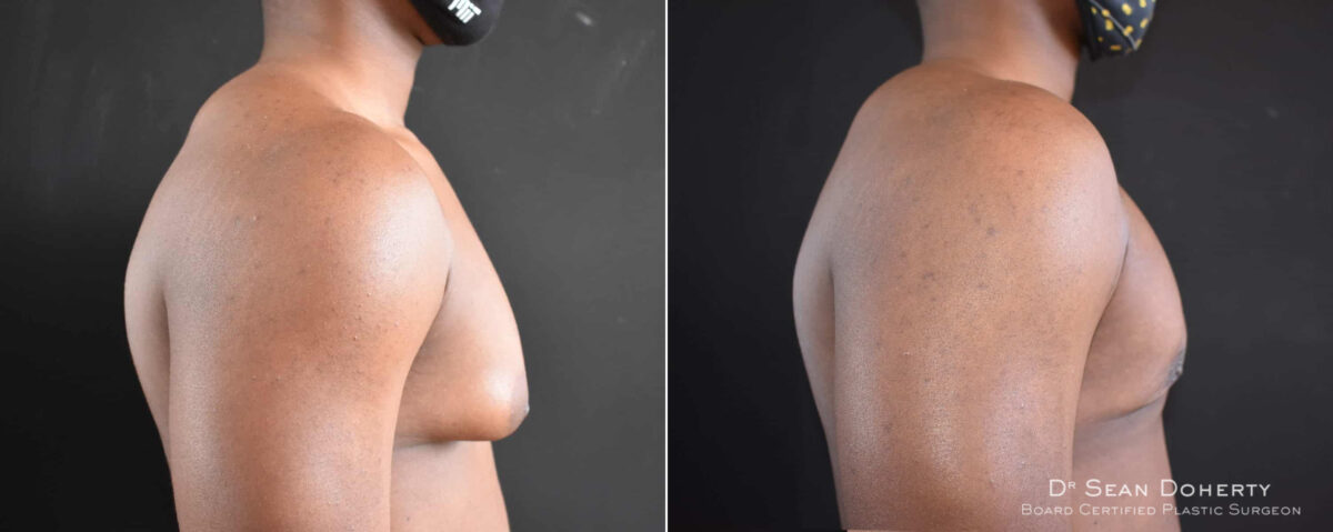 Gynecomastia Before and After Photos in Boston, MA, Patient 8351