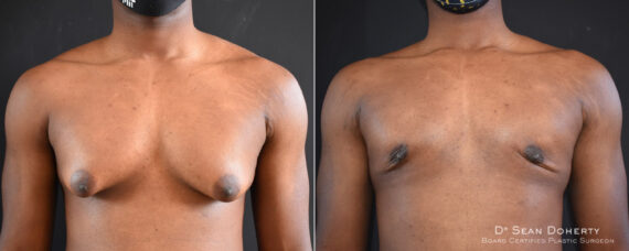 Gynecomastia Before and After Photos in Boston, MA, Patient 8351