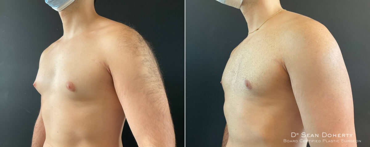 Gynecomastia Before and After Photos in Boston, MA, Patient 8362