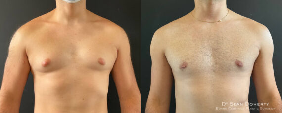 Gynecomastia Before and After Photos in Boston, MA, Patient 8362