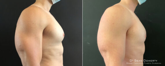 Gynecomastia Before and After Photos in Boston, MA, Patient 8417