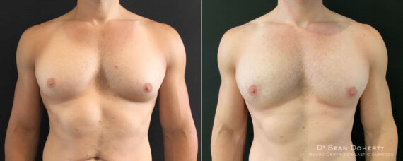 Gynecomastia Before and After Photos in Boston, MA, Patient 8417