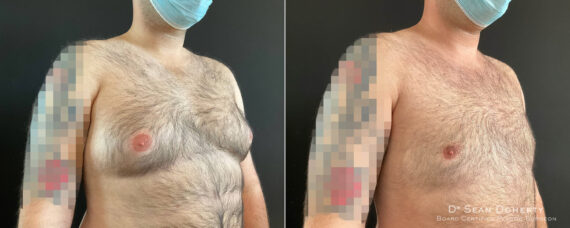Gynecomastia Before and After Photos in Boston, MA, Patient 8444