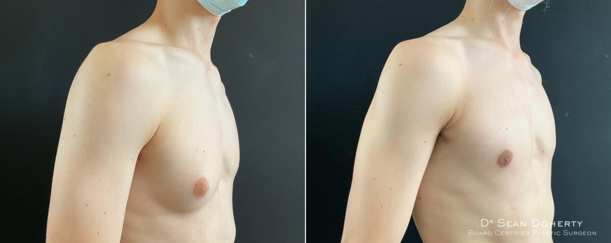 Gynecomastia Before and After Photos in Boston, MA, Patient 8451