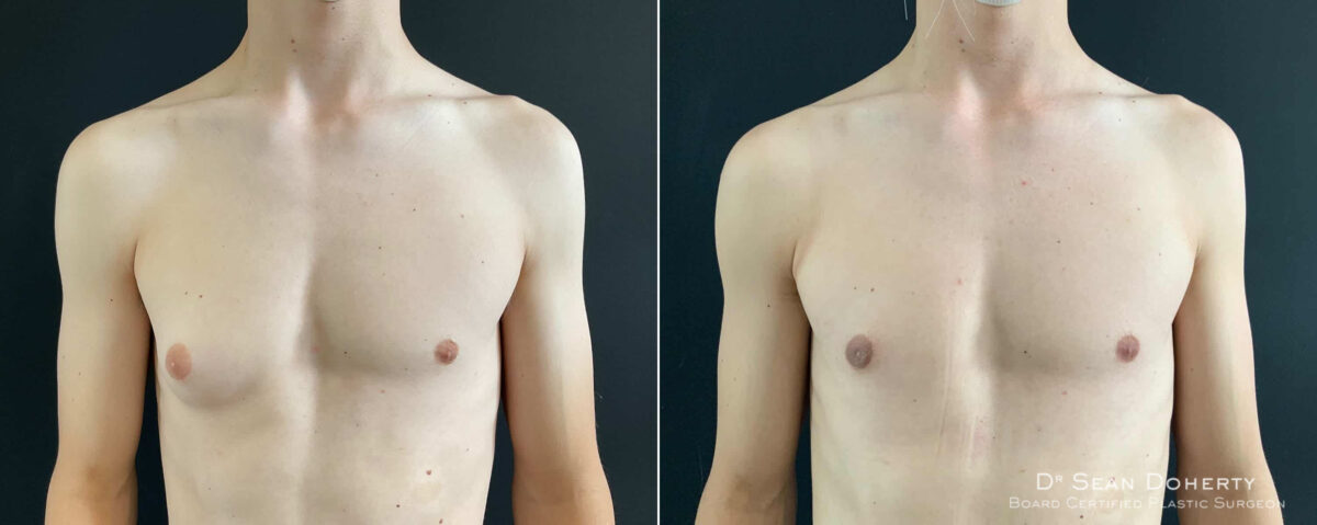 Gynecomastia Before and After Photos in Boston, MA, Patient 8451