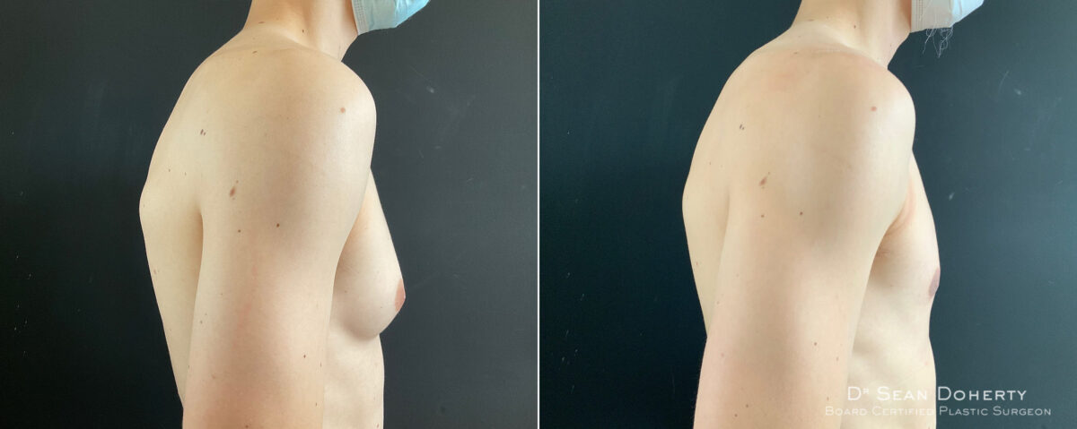 Gynecomastia Before and After Photos in Boston, MA, Patient 8451