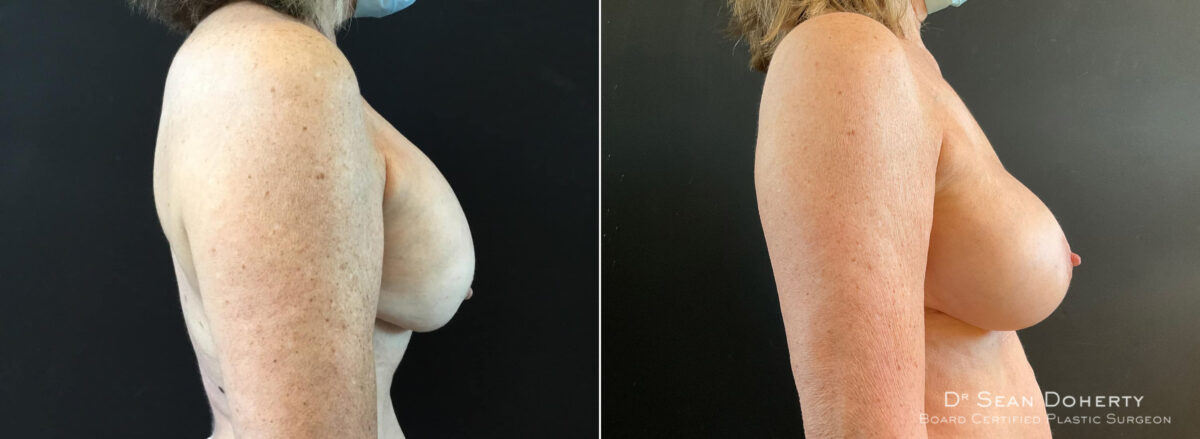 Breast Implant Exchange Before and After Photos in Boston, MA, Patient 8808