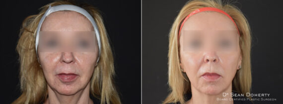 Ablative Laser Before and After Photos in Boston, MA