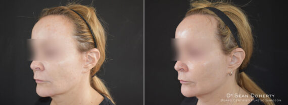 Ablative Laser Before and After Photos in Boston, MA, Patient 9090