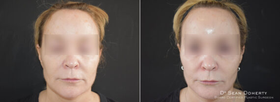 Ablative Laser Before and After Photos in Boston, MA