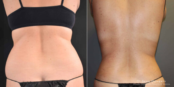 Liposuction Before and After Photos in Boston, MA, Patient 9100