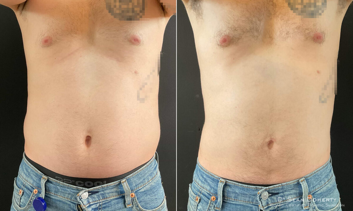Liposuction Before and After Photos in Boston, MA, Patient 9111