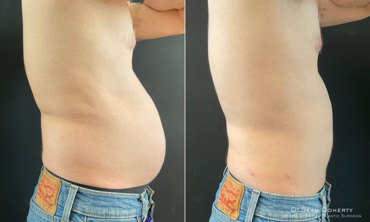Liposuction Before and After Photos in Boston, MA, Patient 9111