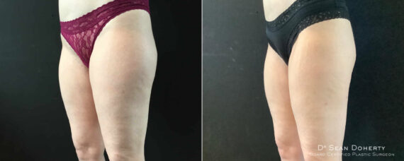 Liposuction Before and After Photos in Boston, MA, Patient 9112