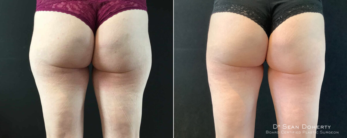 Liposuction Before and After Photos in Boston, MA, Patient 9112