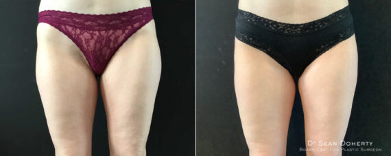 Liposuction Before and After Photos in Boston, MA, Patient 9112