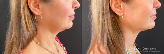 Liposuction Before and After Photos in Boston, MA, Patient 9131