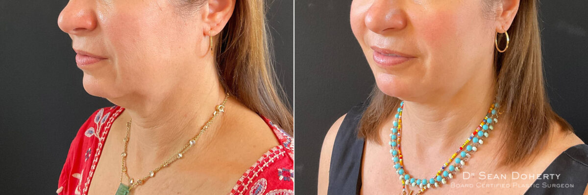 Liposuction Before and After Photos in Boston, MA, Patient 9131