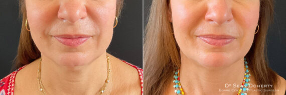Liposuction Before and After Photos in Boston, MA, Patient 9131