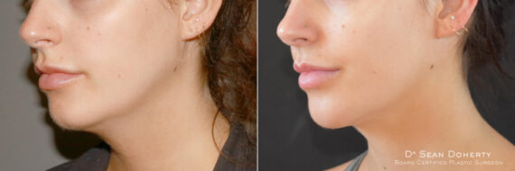 Liposuction Before and After Photos in Boston, MA, Patient 9142