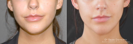 Liposuction Before and After Photos in Boston, MA, Patient 9142