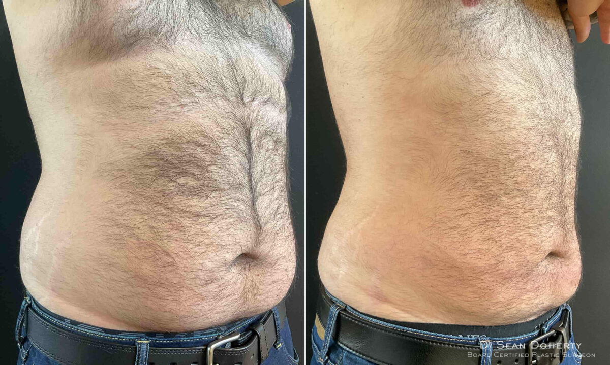 Liposuction Before and After Photos in Boston, MA, Patient 9152