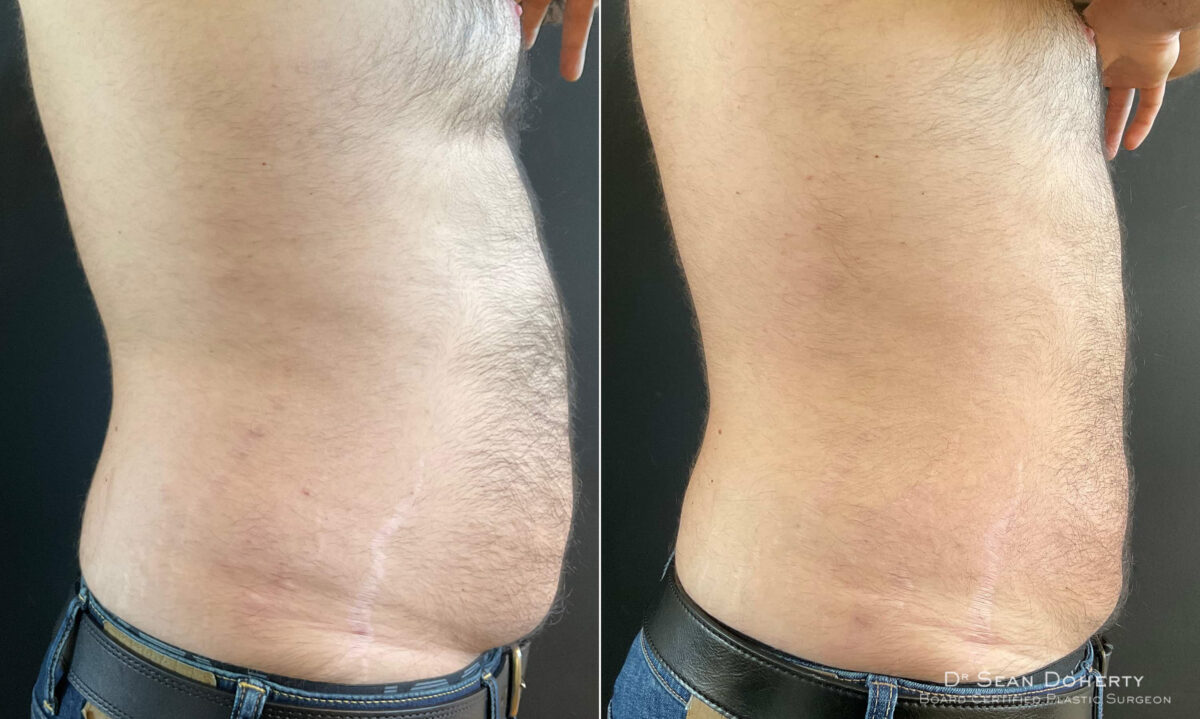 Liposuction Before and After Photos in Boston, MA, Patient 9152